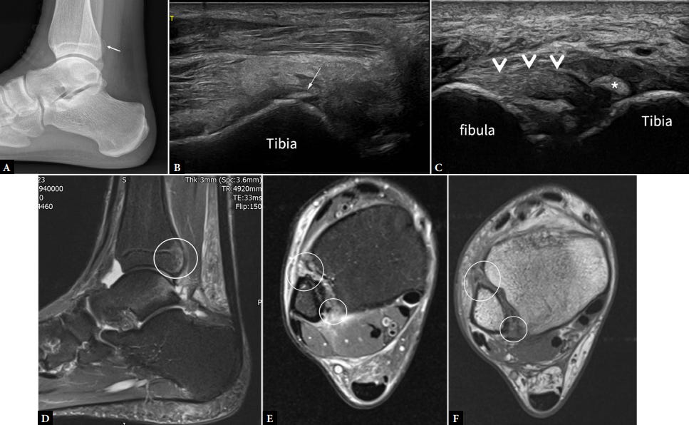 Sindesmosis tibioperonea tempo formacion ecografia 6.jpg